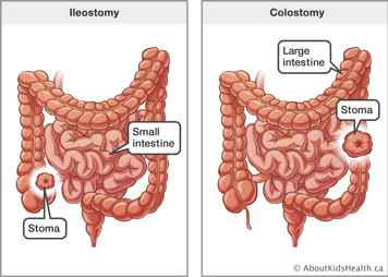 An ileostomy from the small intestine and a colostomy from the large intestine