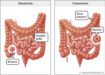 Une iléostomie dans l’intestin grêle et une colostomie dans le gros intestin
