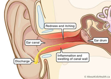 Identification of the ear drum and ear canal with redness and itching, inflammation and swelling of canal wall, and discharge
