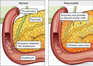 Normal enzyme release into duodenum compared to an inflamed pancreas with enzyme accumulation in injured acinar cells