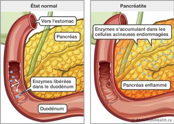 État normal du pancréas comparé à un pancréas enflammé avec accumulation des enzymes dans les cellules acineuses endommagées