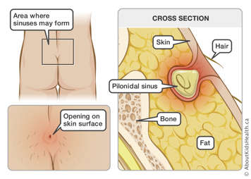 Buttocks with area where sinuses may form identified and a cross section locating hair, skin, pilonidal sinus, bone and fat