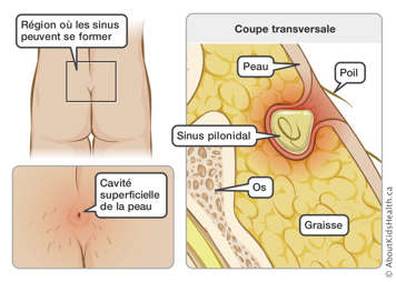 Une coupe transversale identifiant le poil, la peau, le sinus pilonidal, l’os et la graisse dans la région dessus les fesses