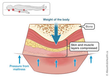 Bone and compressed skin and muscle layers between an arrow showing weight of body and arrows showing pressure from mattress