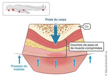 Os et couches de peau et de muscle comprimées entre des flèches montrant l’impact du poids du corp et la pression du metelas