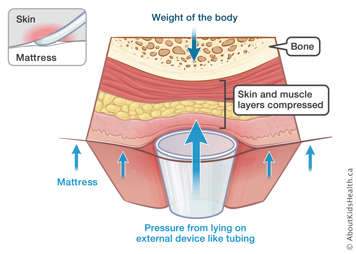 Arrows showing impact of pressures on bone, skin and muscle layers from weight of the body and from lying on external device