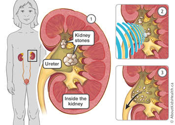 Illustration of kidney stones inside the kidney during shockwave lithotripsy