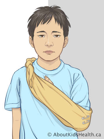 Child wearing sling tied over shoulder on uninjured side and held together at the elbow of the other arm with safety pins
