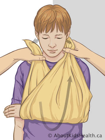 Passant le bandage dessous et puis au-dessus du bras blessé de l'enfant et attachant les coins derrière son cou