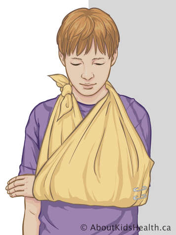 Child wearing a sling tied behind the neck and held together at the elbow with safety pins to hold the arm across their chest