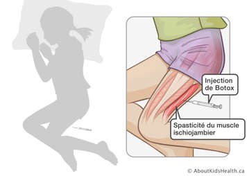 Une aiguille injectant de Botox dans la jambe pour traiter la spasticité du muscle ischiojambier