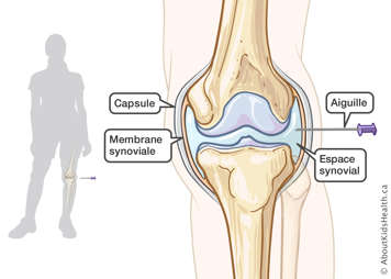Une aiguille insérée dans l’espace synovial de l’articulation du genou