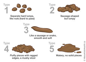 illustration showing different consistencies of poo