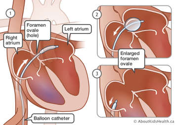 A balloon catheter inserted through the foramen ovale between the right and left atriums of the heart