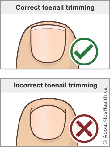 Illustration of correct toenail trimming and incorrect toenail trimming