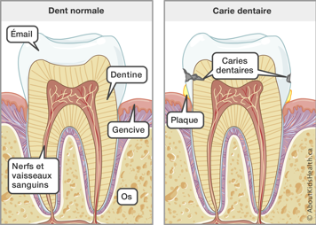 Illustration de l’anatomie d’une dent normale et d’une dent avec carie dentaire