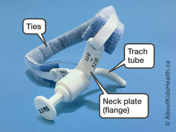 Tracheostomy ties attached to the neck plates of a trach tube