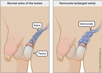 Illustration of normal veins of the testes and of varicocele (enlarged veins)