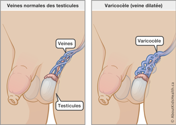 Illustration des veines normales des testicules et de varicocèle (veine dilatée)