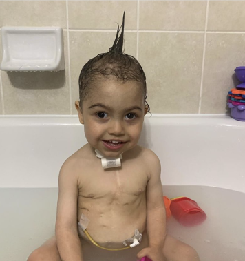 Child with a tracheostomy tube in a bath