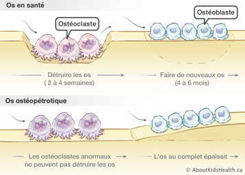 Un os ostéopétrotique avec les ostéclastes abnormaux comparé à un os en santé