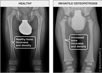 X-ray of thighs with healthy bone thickness and density and x-ray of thighs with increased bone thickness and density