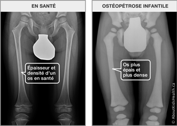 Images de rayon X des fémurs, l’un avec l’épaisseur et la densité d’un os en santé et l’autre avec l’os plus épais et dense