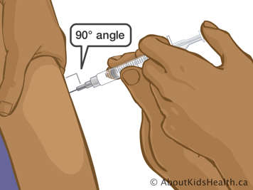Inserting needle into upper arm at a ninety-degree angle
