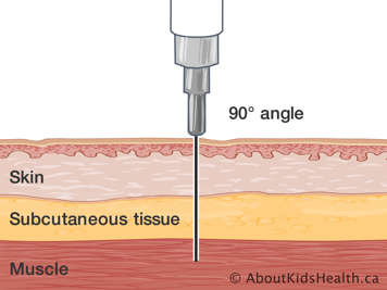 Cross-section of skin, subcutaneous tissue and muscle with needle injected at a ninety-degree angle