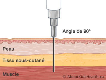 Le peau, le tissu sous-cutané et le muscle avec une aiguille insérée à un angle de quatre-vingt-dix degrés