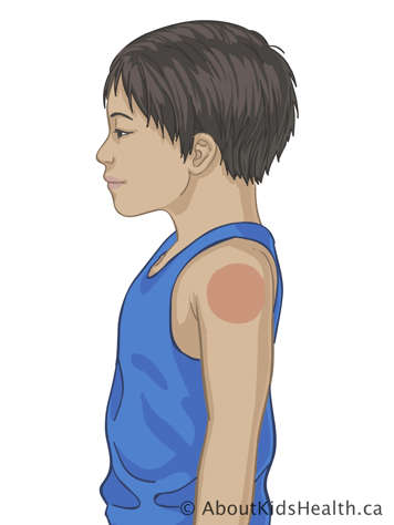 Upper body of child with marking on upper arm near the shoulder