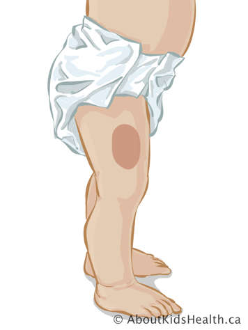 Le bas du corps d’un bébé avec une marque sur la cuisse