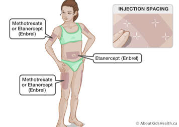 Identification of injection sites of methotrexate and etanercept on a girl’s body
