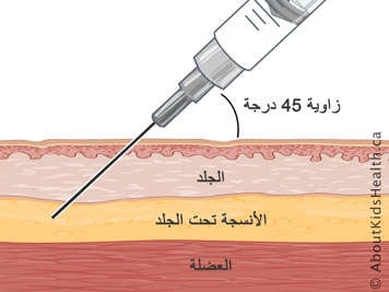 مقطع عرضي للجلد والأنسجة تحت الجلد والعضلات بإبرة محقونة بزاوية 45 درجة