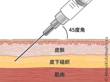 以 45 度角注射针头的皮肤、皮下组织和肌肉的横截面