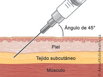 Corte transversal de piel, tejido subcut&aacute;neo y m&uacute;sculo con aguja inyectada en un &aacute;ngulo de 45 grados