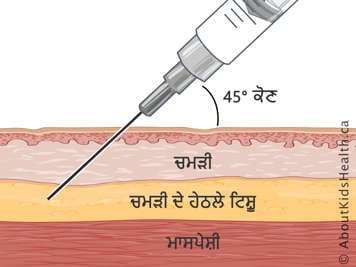 45-ਡਿਗਰੀ ਦੇ ਕੋਣ 'ਤੇ ਸੂਈ ਦੇ ਟੀਕੇ ਨਾਲ ਚਮੜੀ, ਚਮੜੀ ਦੇ ਹੇਠਲੇ ਟਿਸ਼ੂ ਅਤੇ ਮਾਸਪੇਸ਼ੀਆਂ ਦਾ ਕਰਾਸ-ਸੈਕਸ਼ਨ