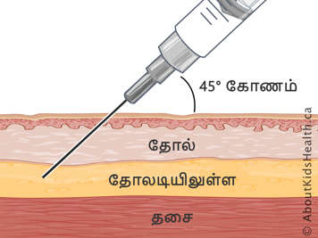 45 டிகிரி கோணத்தில் ஊசி செலுத்தப்பட்டு தோல், தோலடி திசு மற்றும் தசையின் குறுக்குவெட்டு