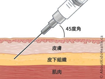 以 45 度角注射針頭的皮膚、皮下組織和肌肉的橫切面