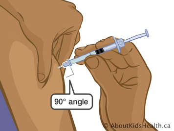 Inserting needle into upper arm at a ninety-degree angle