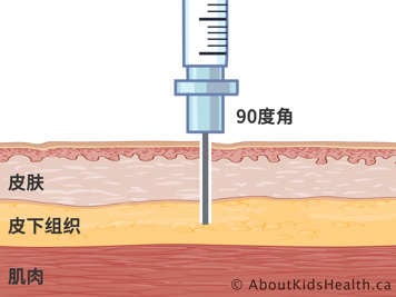 以九十度角注射针头的皮肤、皮下组织和肌肉的横截面