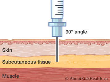 Cross-section of skin, subcutaneous tissue and muscle with needle injected at a ninety-degree angle