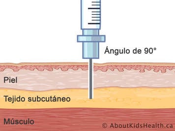 Corte transversal de piel, tejido subcut&aacute;neo y m&uacute;sculo con aguja inyectada en un &aacute;ngulo de noventa grados