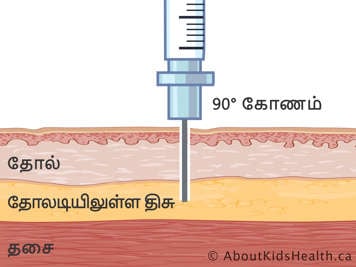 தொண்ணூறு டிகிரி கோணத்தில் ஊசி செலுத்தப்பட்டு தோல், தோலடி திசு மற்றும் தசையின் குறுக்குவெட்டு