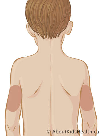 Le haut du corps d’un enfant avec des marques sur l’arrière des parties supérieures des bras