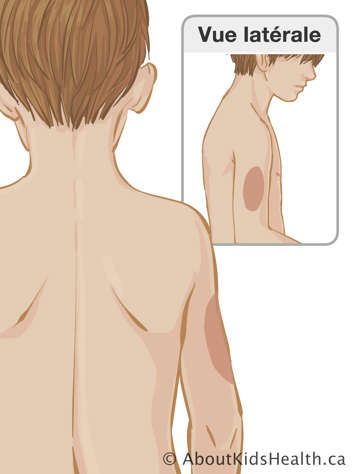 Le haut du corps d’un enfant avec une marque sur la partie supérieure du bras