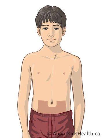 Upper body of child with marking on lower abdomen