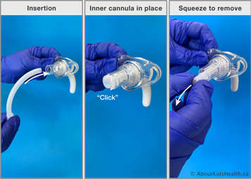 Inner cannula being inserted into the outer cannula, making sure that the inner cannula clicks to lock it in place and squeezing the outer edges of the inner cannula to remove it