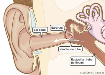 Ventilation tube in ear allowing air to pass from Eustachian tube to the ear canal