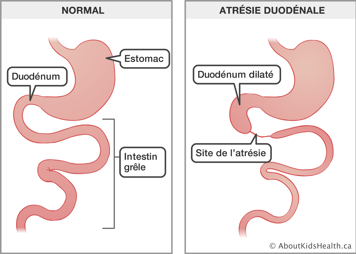 Estomac, duodénum et intestin grêle normaux et une illustration de l’atrésie duodénale avec la site de l’atrésie identifiée